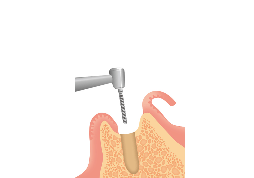 人工の歯根（インプラント体）の埋入