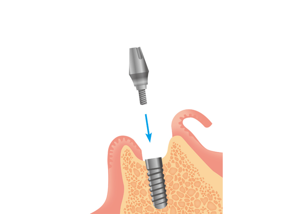 アバットメントの装着