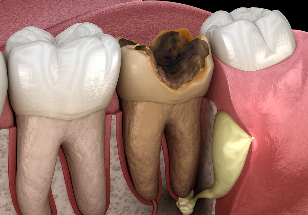 むし歯が神経に達するとどうなる？