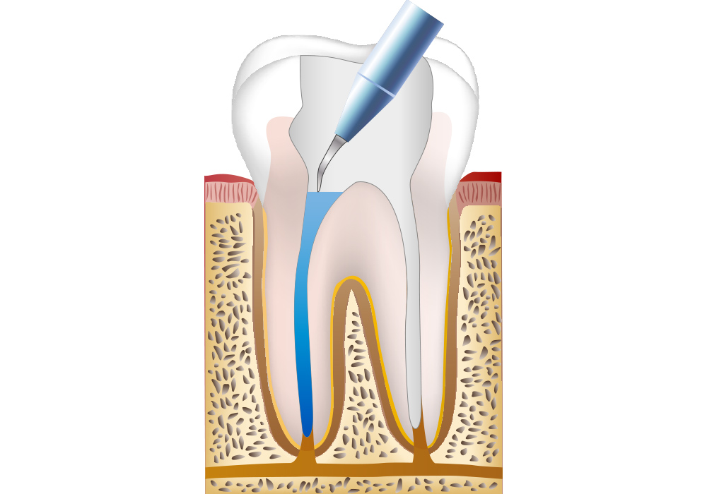 根管の内部を洗浄