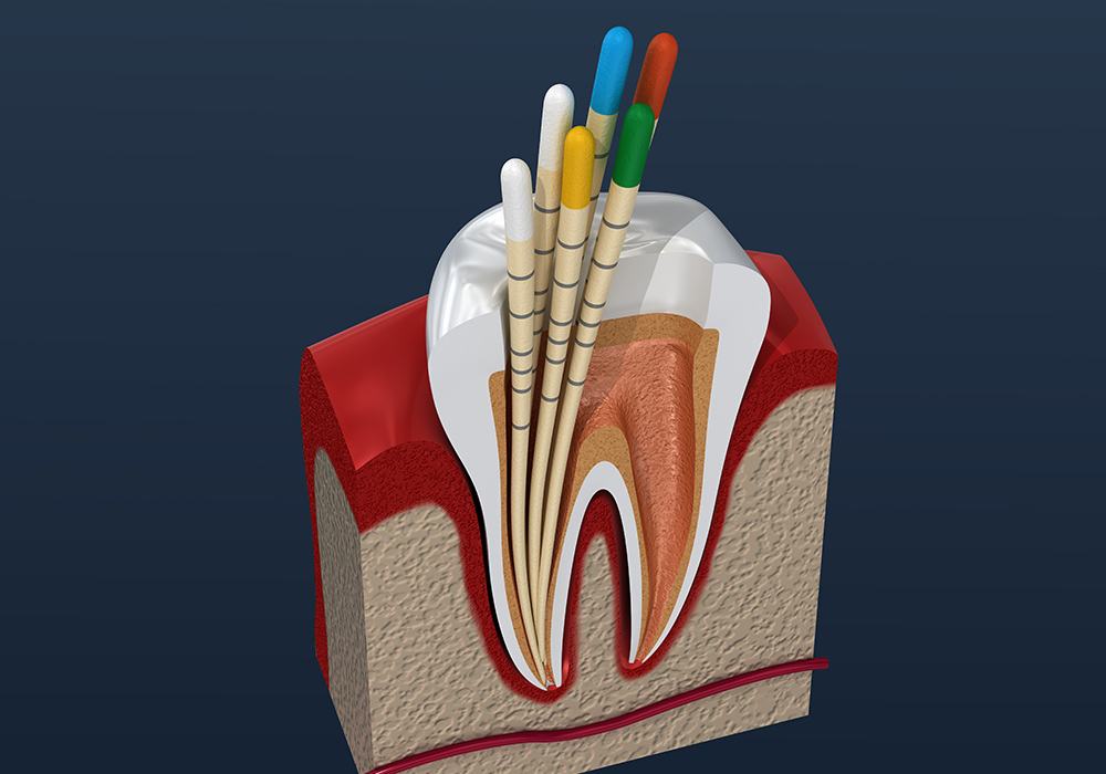 薬剤を充填する