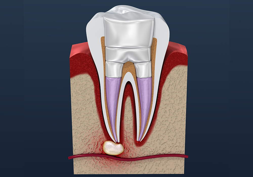 仮歯でふたをする