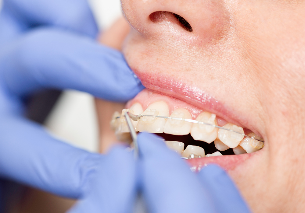 矯正装置の装着