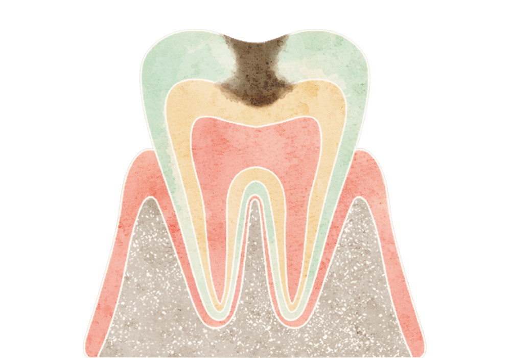 象牙質まで進行したむし歯（C2）