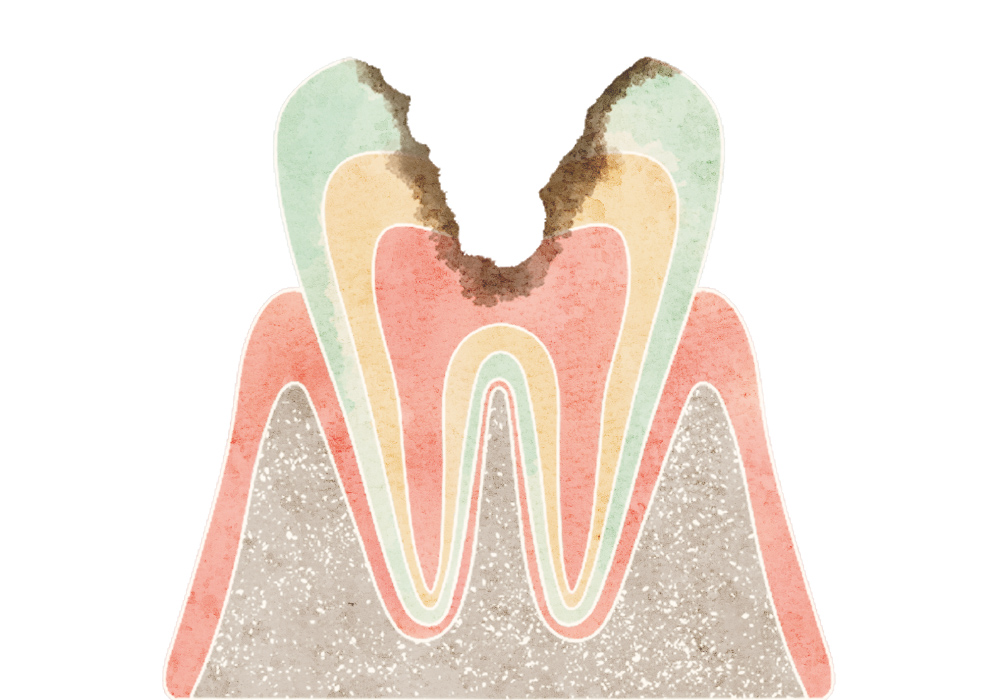 神経に達したむし歯（C3）