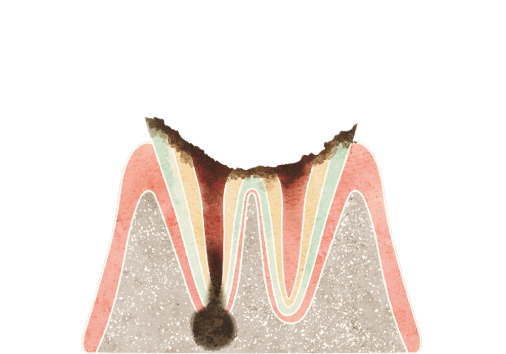 歯根に達したむし歯（C4）