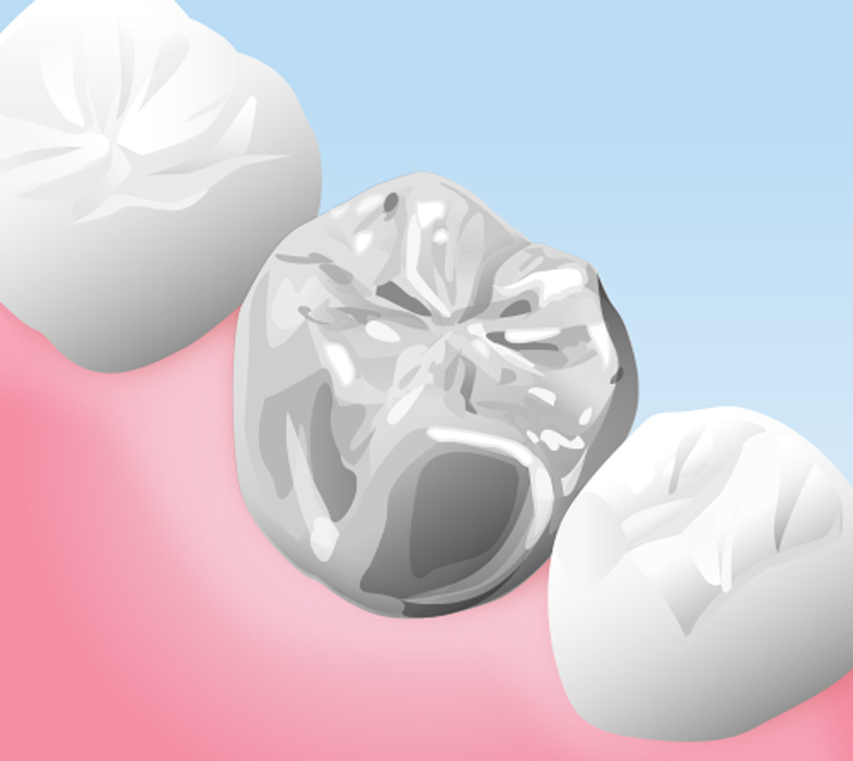 銀色の詰め物・被せ物（銀歯）