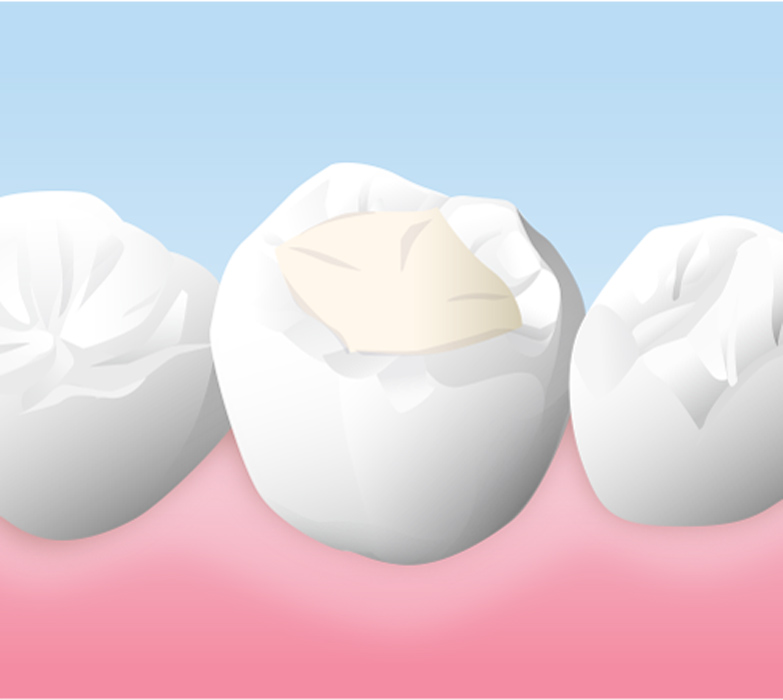 コンポジットレジンの詰め物・被せ物