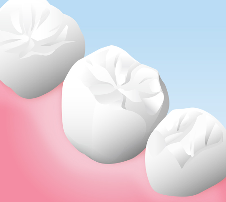 セラミックの詰め物・被せ物