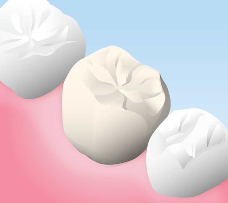 ハイブリッドの詰め物・被せ物