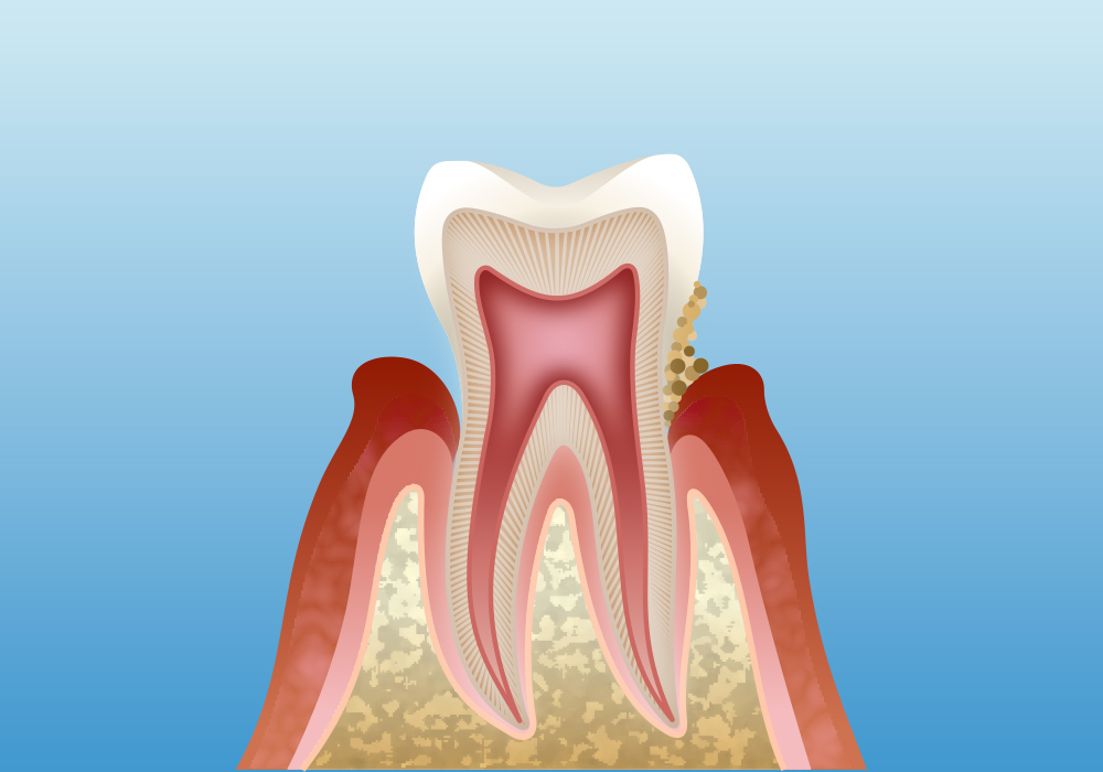 軽度の歯周炎